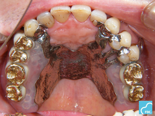 金属プレート義歯
